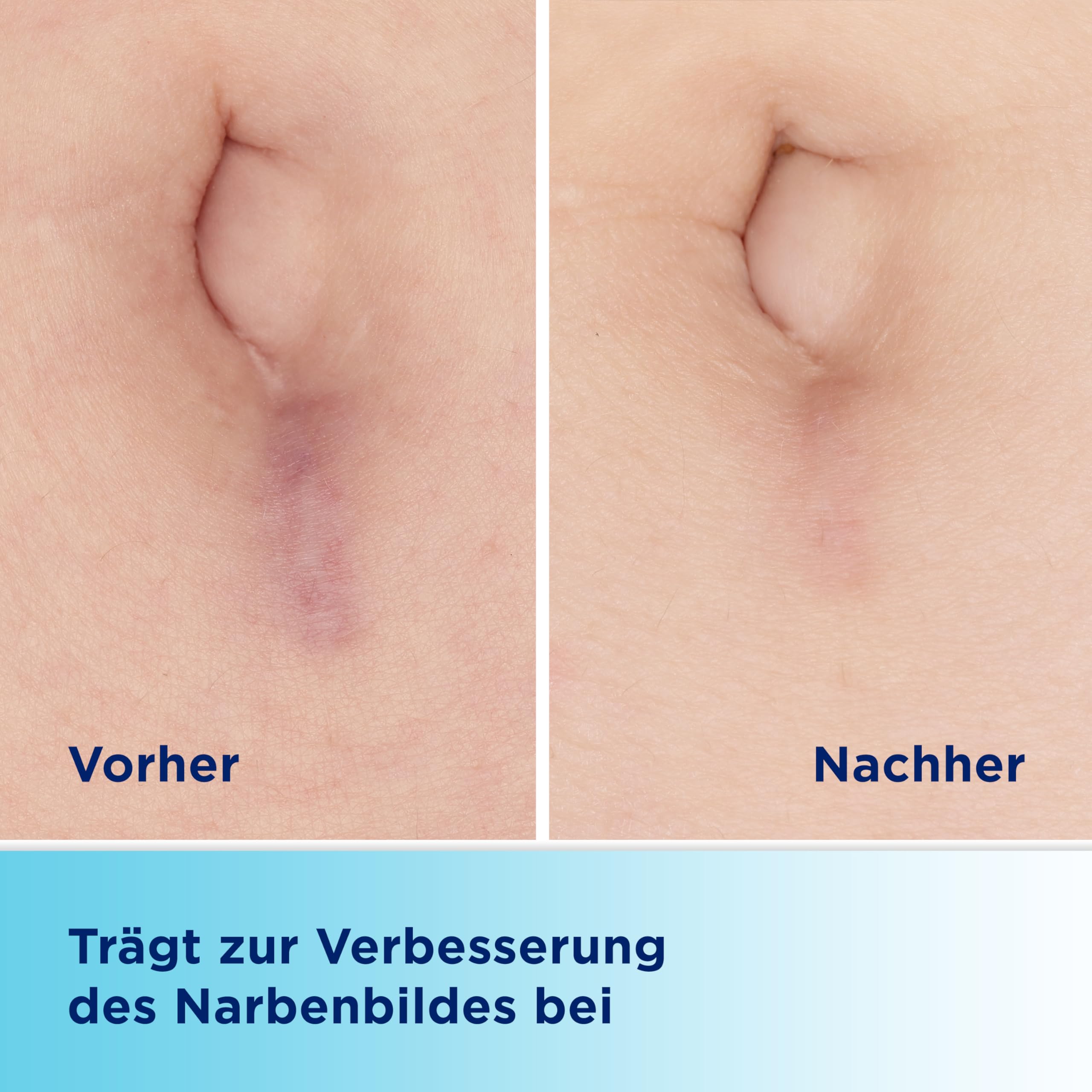 bepanthen-bepancare-narben-gel-20g-mit-massage-roller image 3